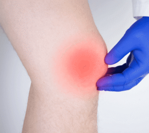 inflamed knee